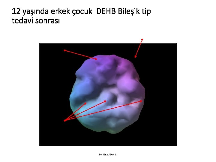 12 yaşında erkek çocuk DEHB Bileşik tip tedavi sonrası Dr. Esat ŞANLI 