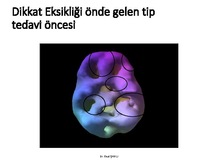 Dikkat Eksikliği önde gelen tip tedavi öncesi Dr. Esat ŞANLI 