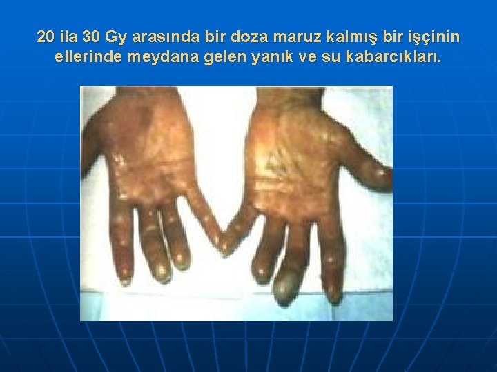 20 ila 30 Gy arasında bir doza maruz kalmış bir işçinin ellerinde meydana gelen