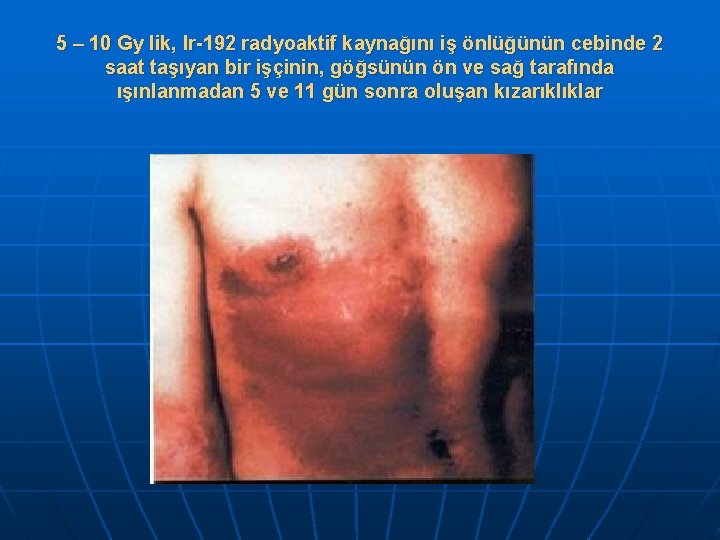 5 – 10 Gy lik, Ir-192 radyoaktif kaynağını iş önlüğünün cebinde 2 saat taşıyan