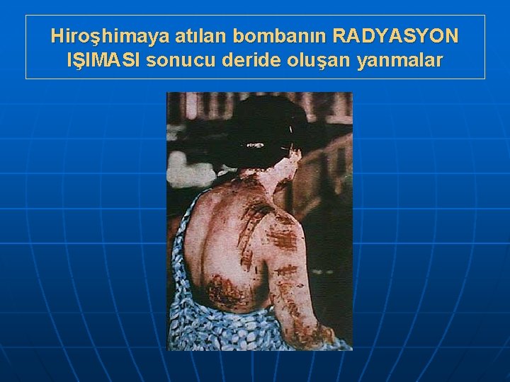 Hiroşhimaya atılan bombanın RADYASYON IŞIMASI sonucu deride oluşan yanmalar 