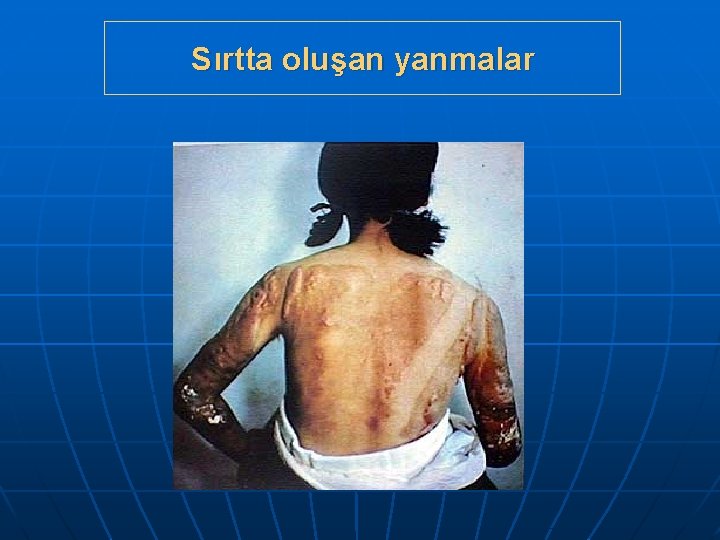 Sırtta oluşan yanmalar 