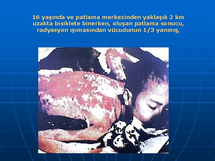 16 yaşında ve patlama merkezinden yaklaşık 2 km uzakta bisiklete binerken, oluşan patlama sonucu,