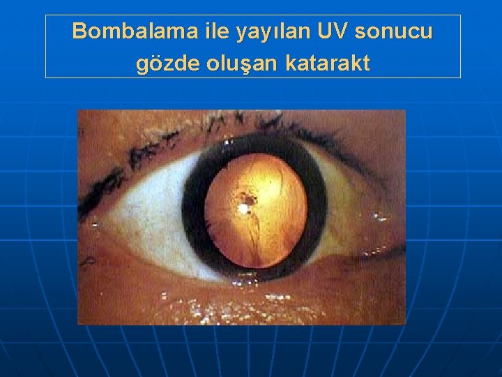 Bombalama ile yayılan UV sonucu gözde oluşan katarakt 