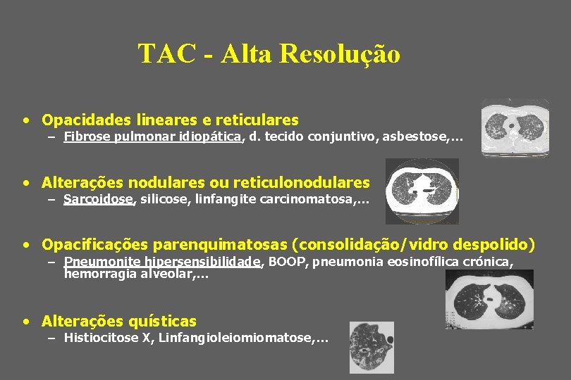 TAC - Alta Resolução • Opacidades lineares e reticulares – Fibrose pulmonar idiopática, d.