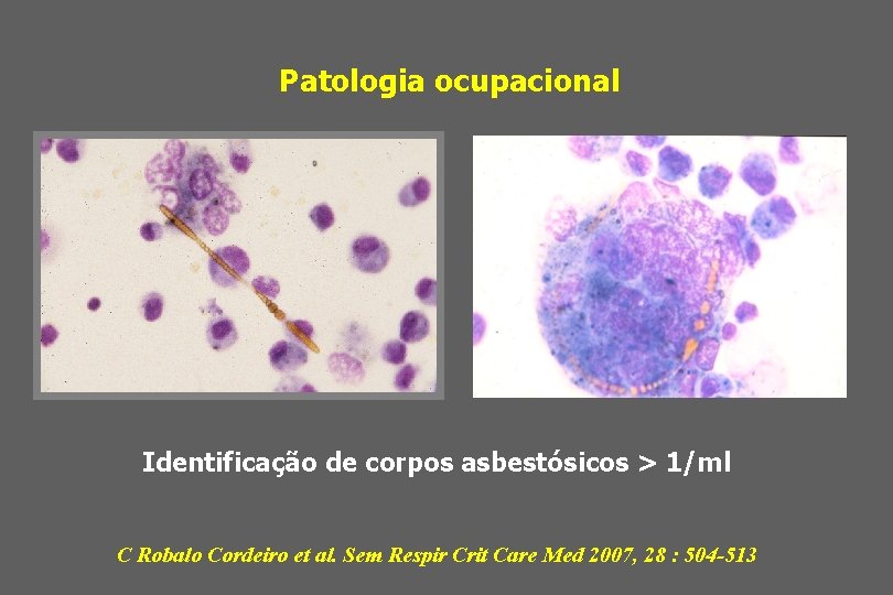 Patologia ocupacional Identificação de corpos asbestósicos > 1/ml C Robalo Cordeiro et al. Sem