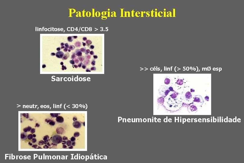 Patologia Intersticial linfocitose, CD 4/CD 8 > 3. 5 >> céls, linf (> 50%),
