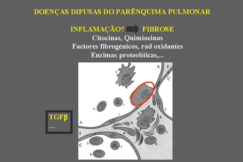 DOENÇAS DIFUSAS DO PARÊNQUIMA PULMONAR INFLAMAÇÃO? FIBROSE Citocinas, Quimiocinas Factores fibrogénicos, rad oxidantes Enzimas