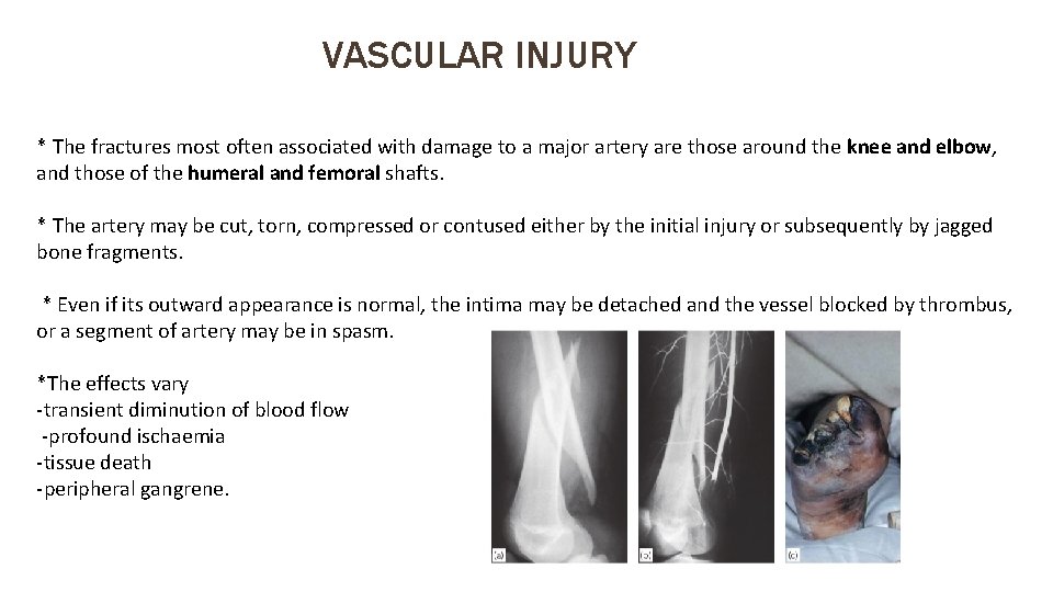 VASCULAR INJURY * The fractures most often associated with damage to a major artery