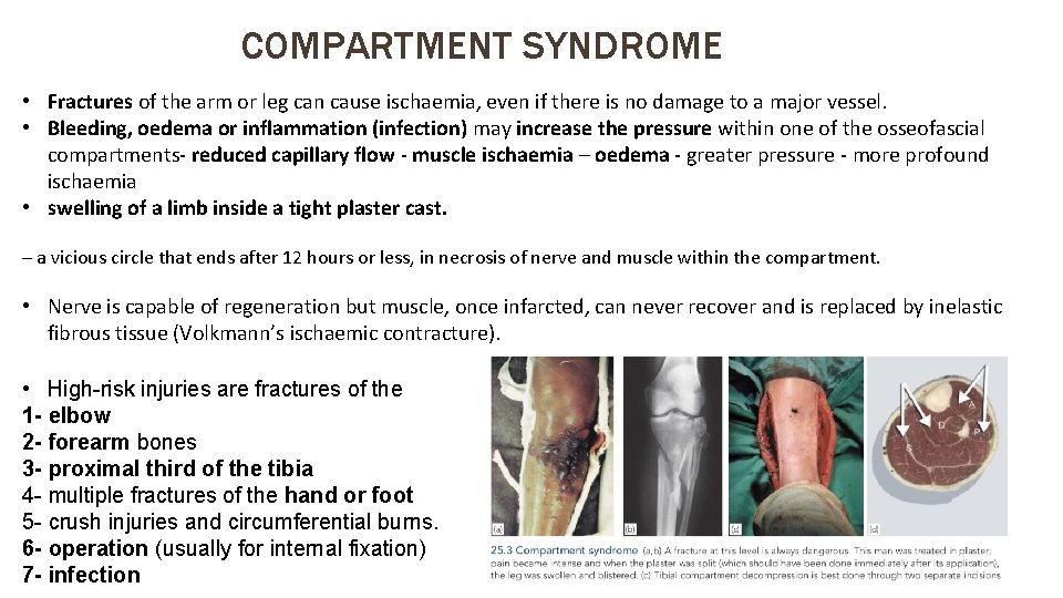 COMPARTMENT SYNDROME • Fractures of the arm or leg can cause ischaemia, even if