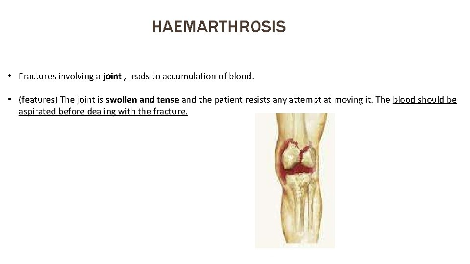 HAEMARTHROSIS • Fractures involving a joint , leads to accumulation of blood. • (features)