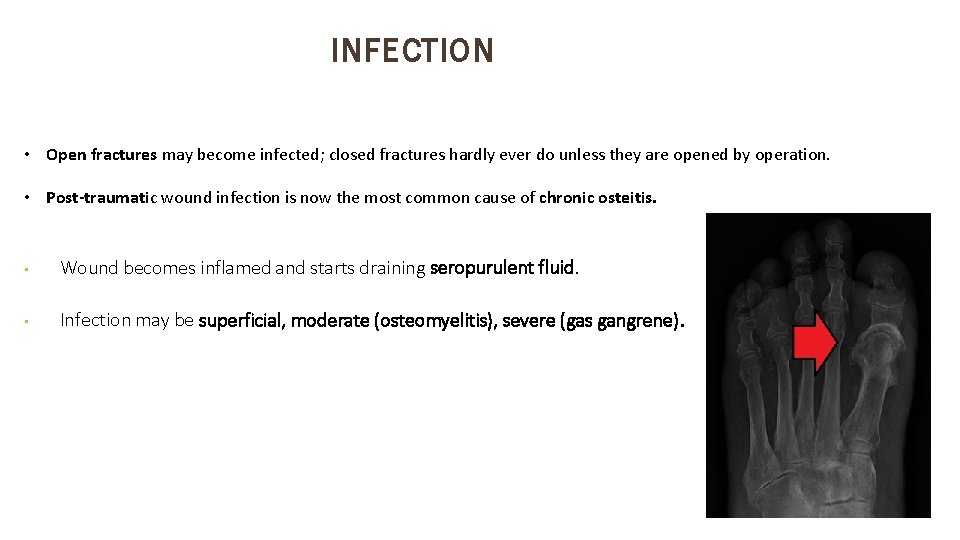 INFECTION • Open fractures may become infected; closed fractures hardly ever do unless they