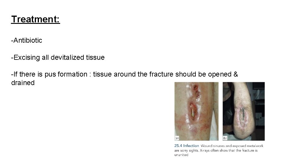 Treatment: -Antibiotic -Excising all devitalized tissue -If there is pus formation : tissue around