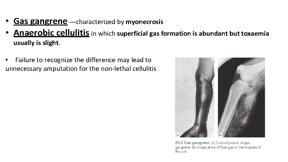  • Gas gangrene ---characterized by myonecrosis • Anaerobic cellulitis in which superficial gas