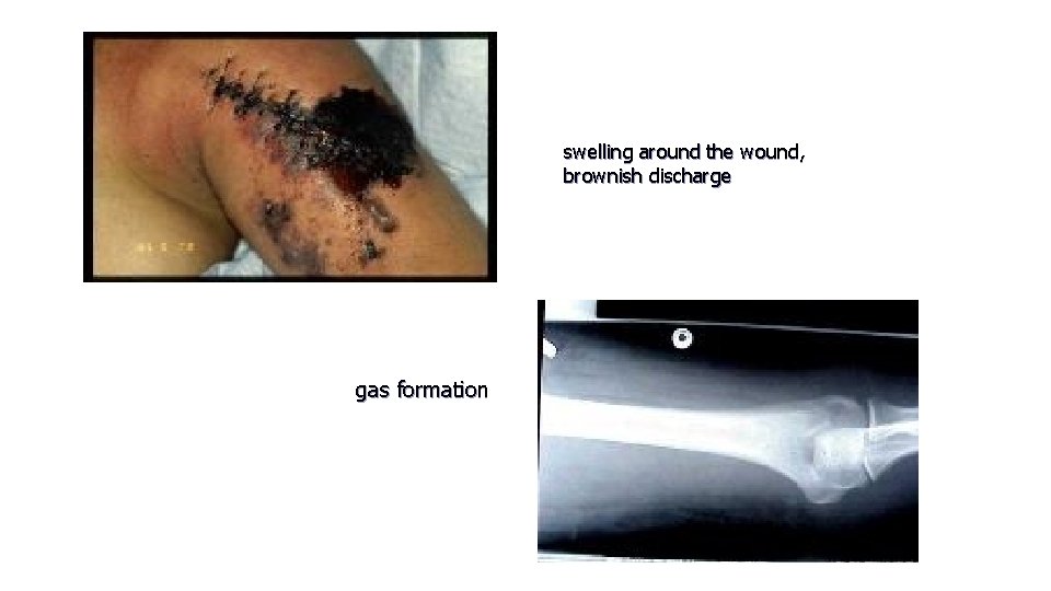 swelling around the wound, brownish discharge gas formation 