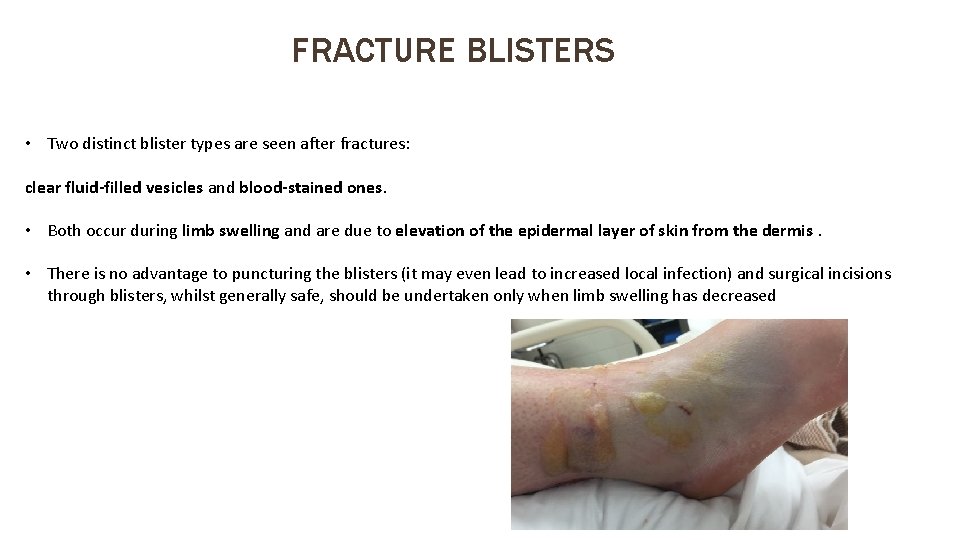 FRACTURE BLISTERS • Two distinct blister types are seen after fractures: clear fluid-filled vesicles