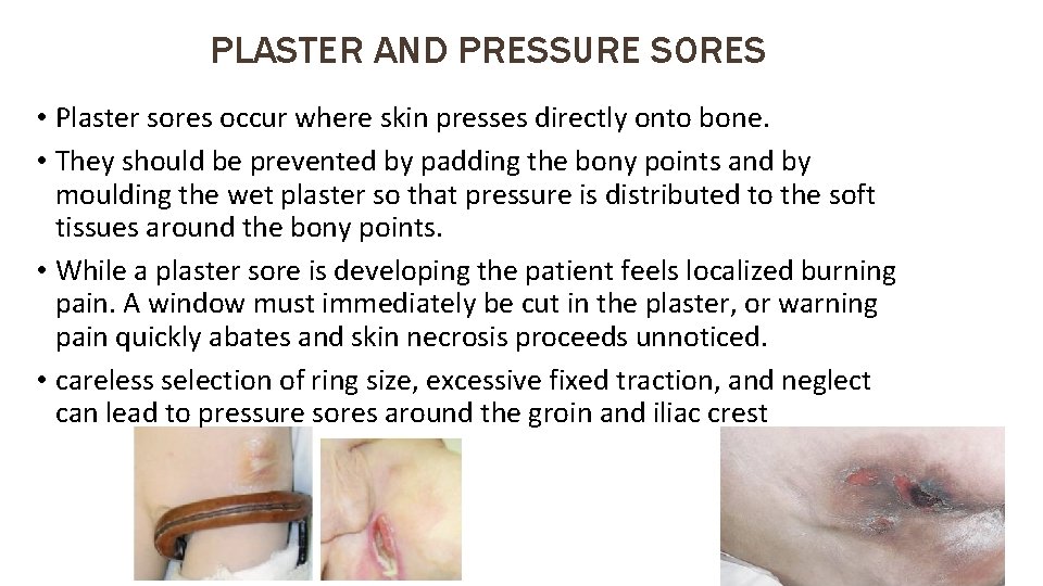 PLASTER AND PRESSURE SORES • Plaster sores occur where skin presses directly onto bone.