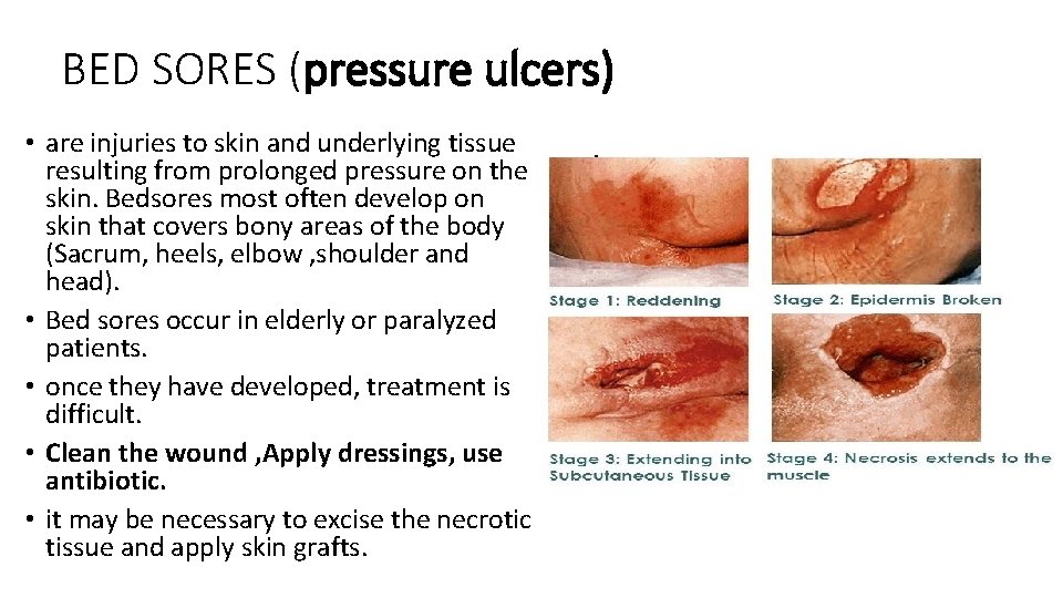 BED SORES (pressure ulcers) • are injuries to skin and underlying tissue resulting from