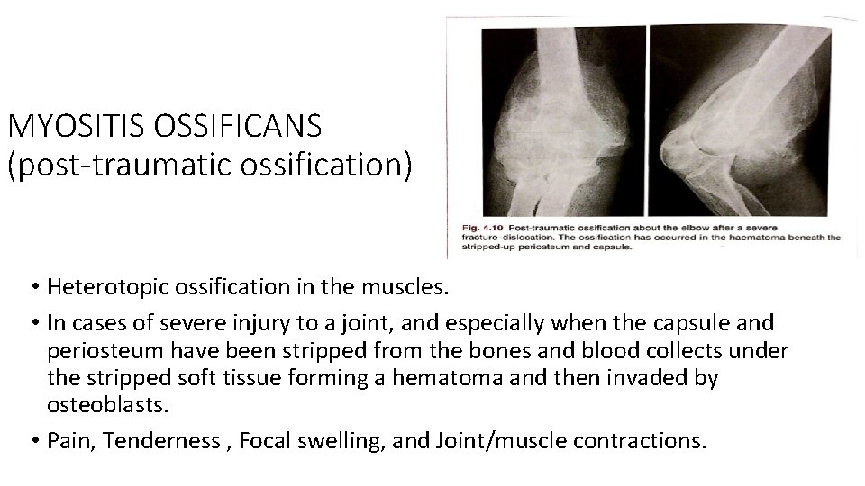 MYOSITIS OSSIFICANS (post-traumatic ossification) • Heterotopic ossification in the muscles. • In cases of