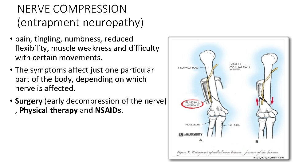 NERVE COMPRESSION (entrapment neuropathy) • pain, tingling, numbness, reduced flexibility, muscle weakness and difficulty