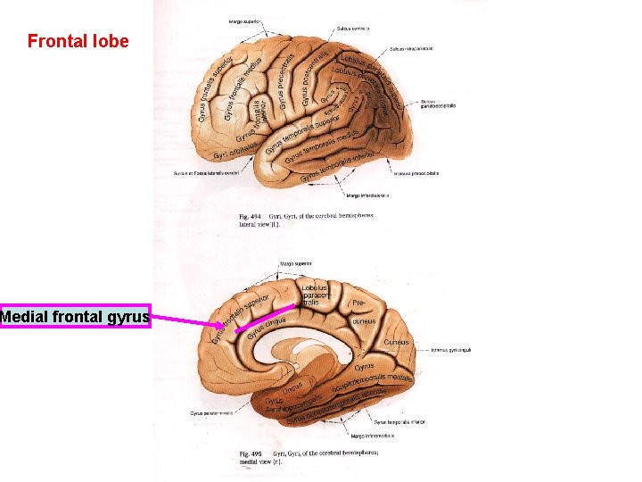 Frontal lobe Medial frontal gyrus 