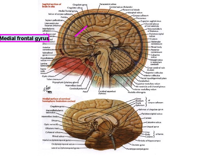 Medial frontal gyrus 