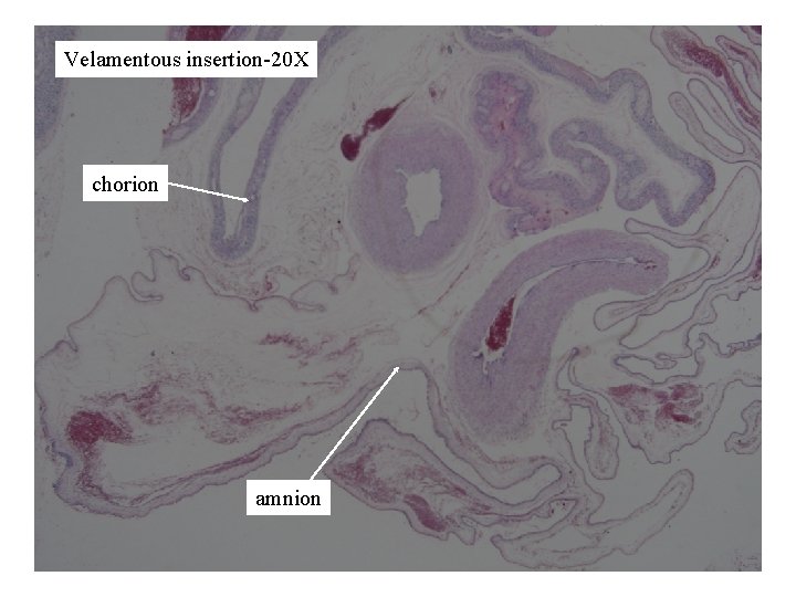 Velamentous insertion-20 X chorion amnion 
