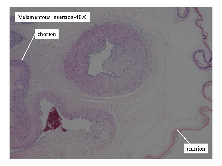 Velamentous insertion-40 X chorion amnion 