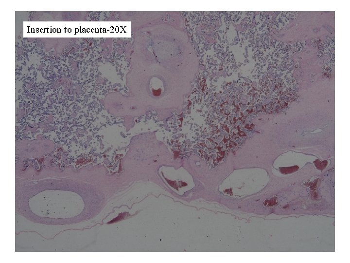 Insertion to placenta-20 X 