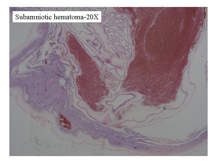 Subamniotic hematoma-20 X 