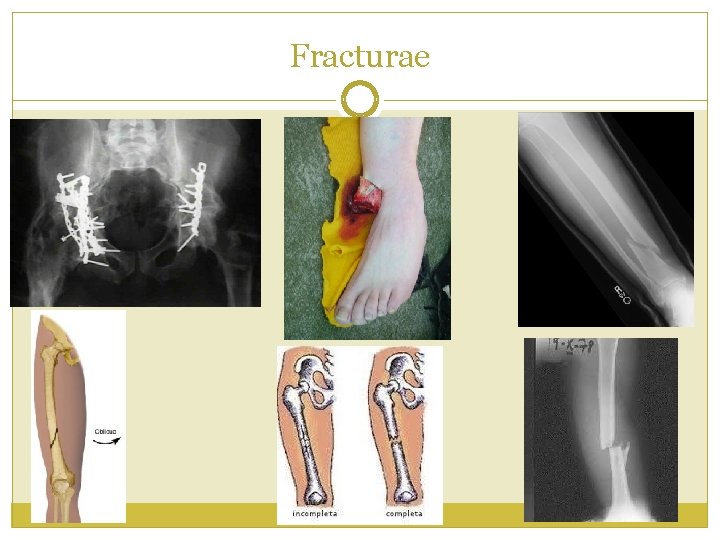 Fracturae 