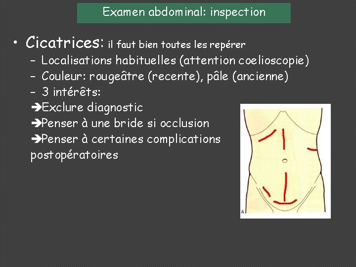 Examen abdominal: inspection • Cicatrices: il faut bien toutes les repérer – Localisations habituelles