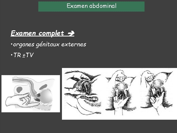 Examen abdominal Examen complet • organes génitaux externes • TR ±TV 