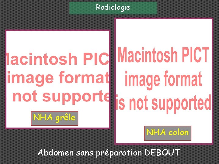 Radiologie NHA grêle NHA colon Abdomen sans préparation DEBOUT 