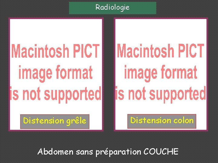 Radiologie Distension grêle Distension colon Abdomen sans préparation COUCHE 