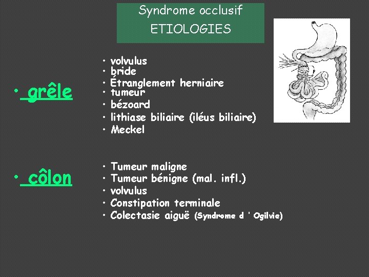 Syndrome occlusif ETIOLOGIES • grêle • côlon • • volvulus bride Étranglement herniaire tumeur