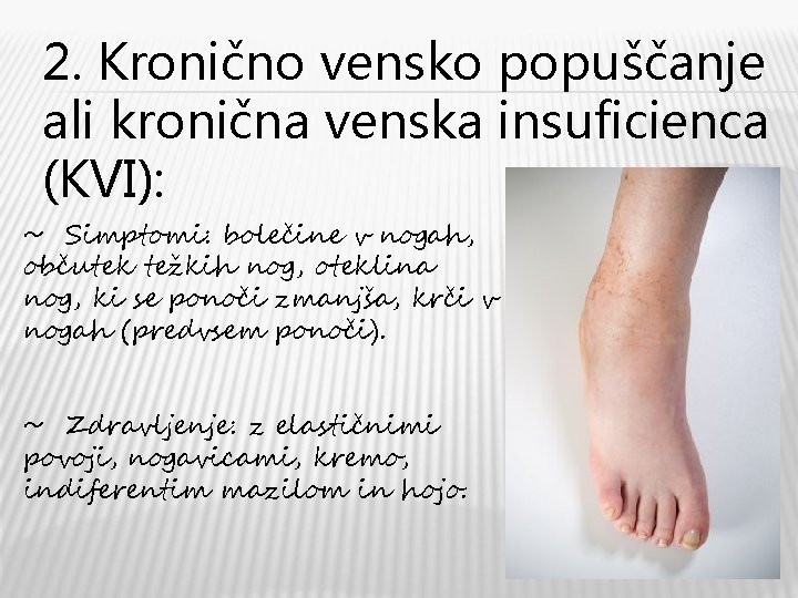 2. Kronično vensko popuščanje ali kronična venska insuficienca (KVI): ~ Simptomi: bolečine v nogah,
