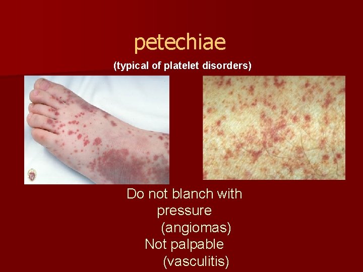 petechiae (typical of platelet disorders) Do not blanch with pressure (angiomas) Not palpable (vasculitis)