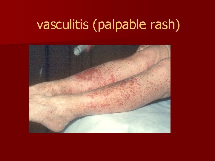 vasculitis (palpable rash) 