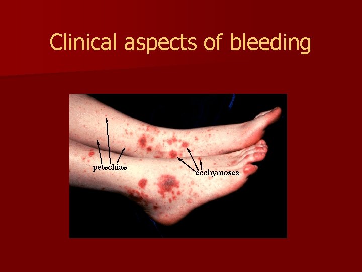 Clinical aspects of bleeding 