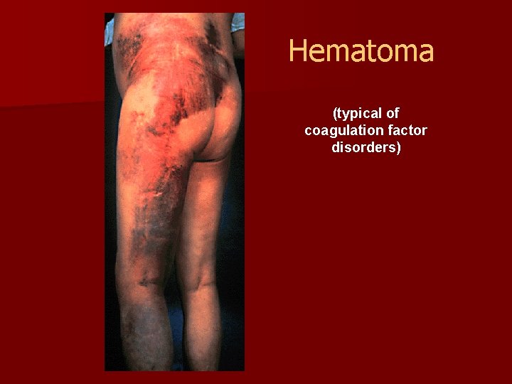 Hematoma (typical of coagulation factor disorders) 