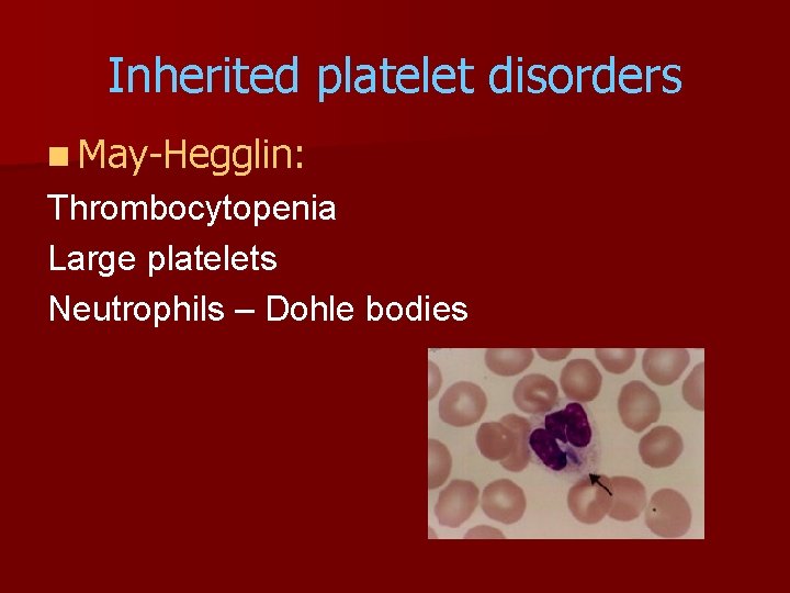 Inherited platelet disorders n May-Hegglin: Thrombocytopenia Large platelets Neutrophils – Dohle bodies 
