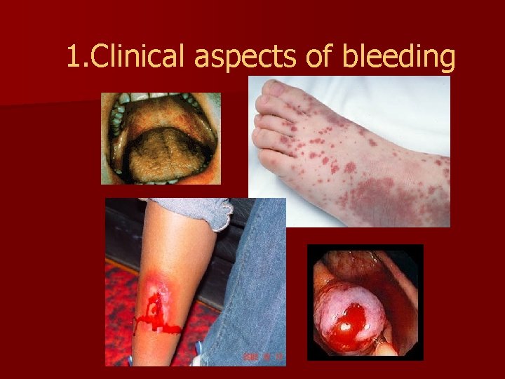 1. Clinical aspects of bleeding 