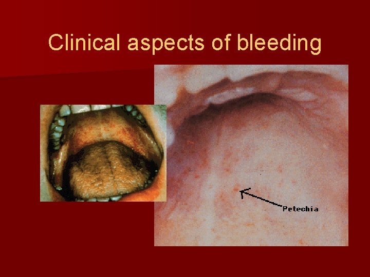 Clinical aspects of bleeding 