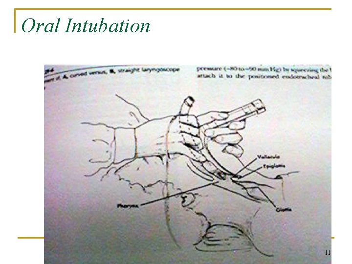 Oral Intubation 11 