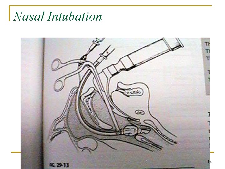 Nasal Intubation 14 