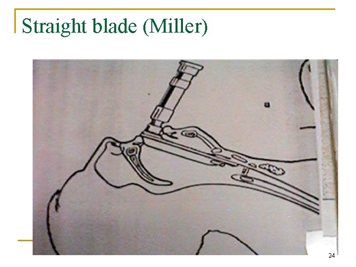 Straight blade (Miller) 24 