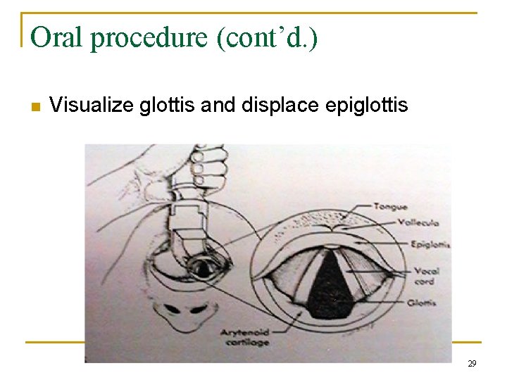 Oral procedure (cont’d. ) n Visualize glottis and displace epiglottis 29 
