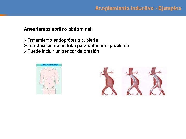 Acoplamiento inductivo - Ejemplos Aneurismas aórtico abdominal ØTratamiento endoprótesis cubierta ØIntroducción de un tubo Acoplamiento inductivo - Ejemplos Aneurismas aórtico abdominal ØTratamiento endoprótesis cubierta ØIntroducción de un tubo