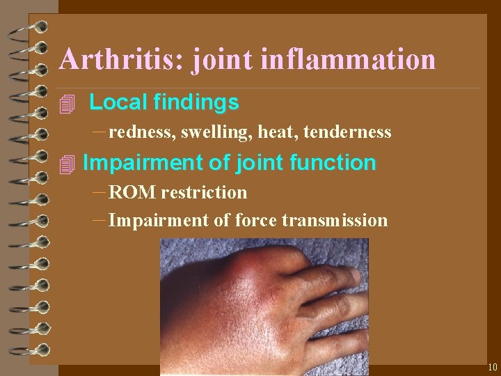 Arthritis: joint inflammation 4 Local findings – redness, swelling, heat, tenderness 4 Impairment of